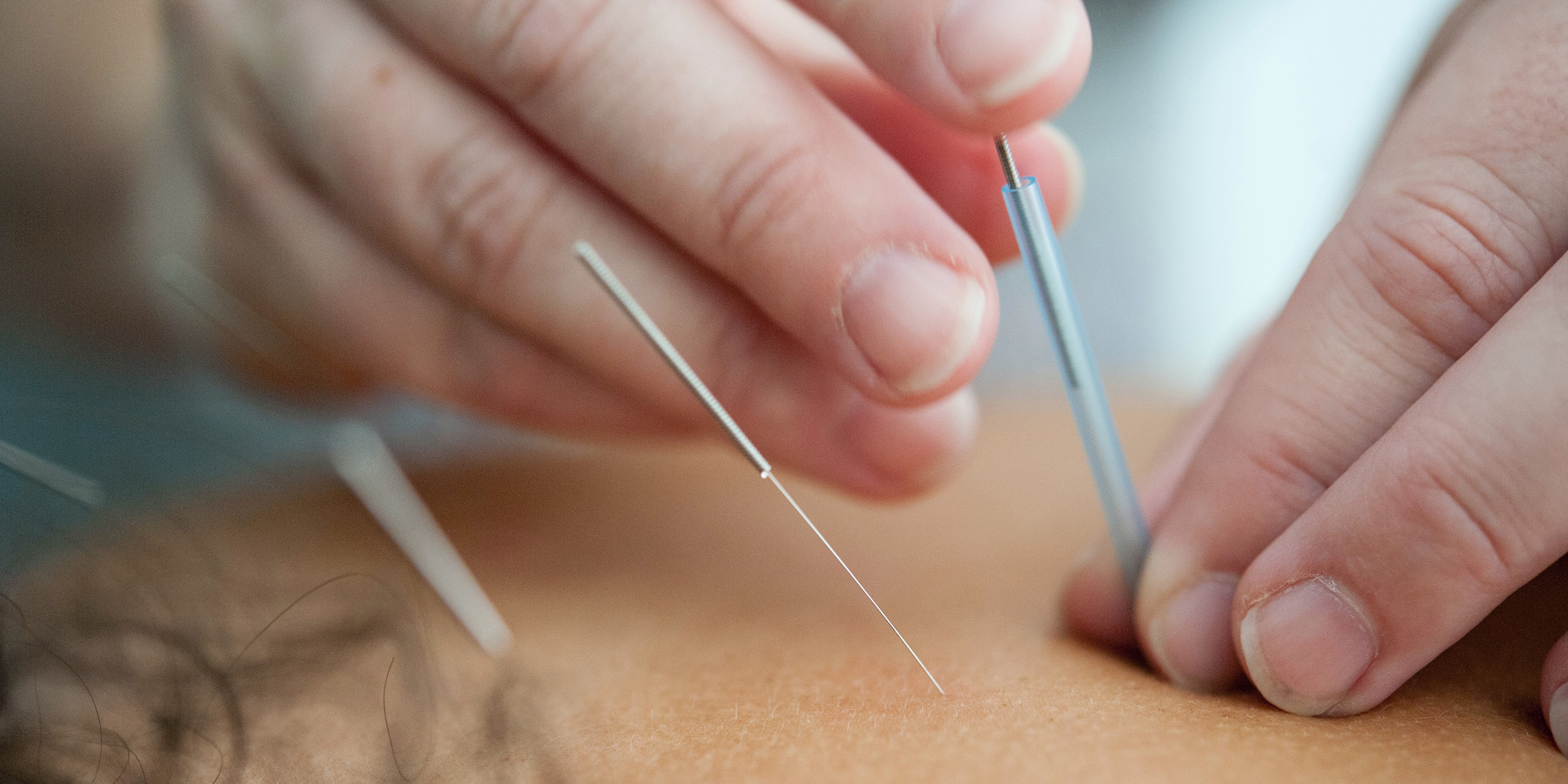 Close-up image of acupuncture needles being applied to a patient